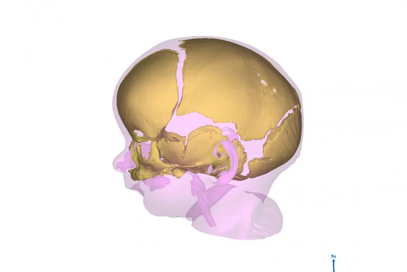 Model of skull of child with craniosynostosis